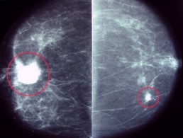 breast cancer mammogram