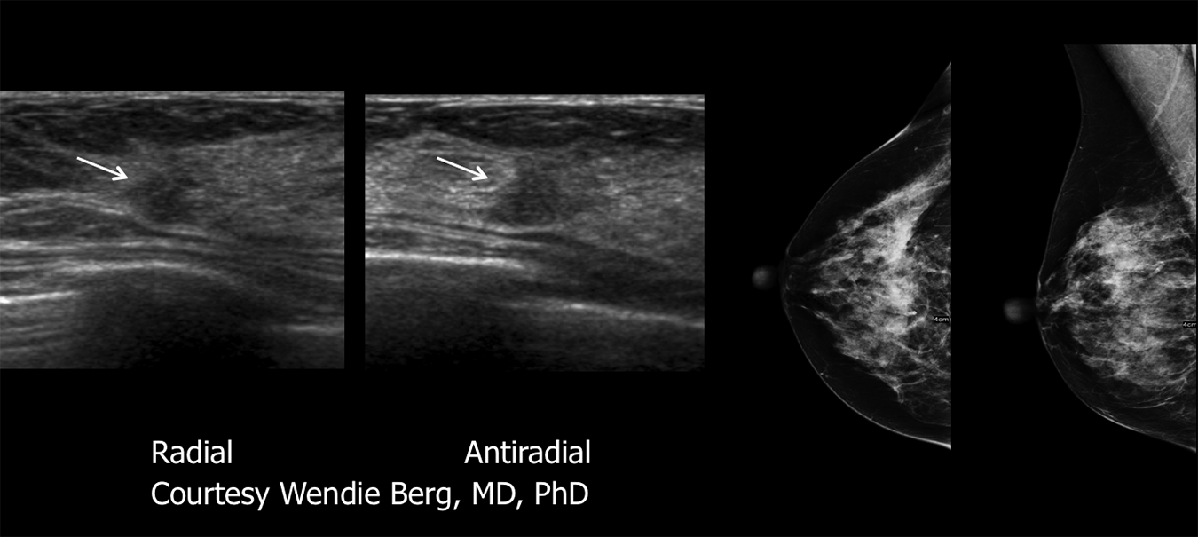 cancer seen on ultraosund with normal mammogram